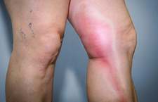 Oppervlakkige Flebitis